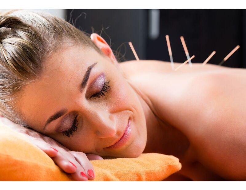 A smiling woman receives acupuncture on her back