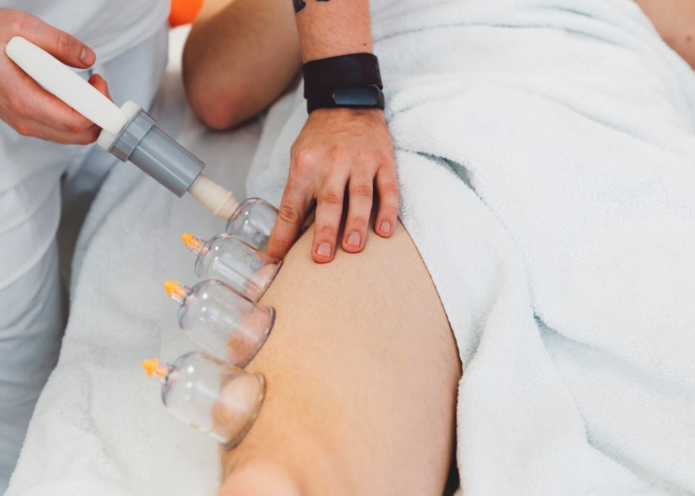 A person receives cupping on the muscles in their thigh